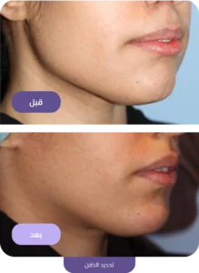 تحديد الفك قبل وبعد