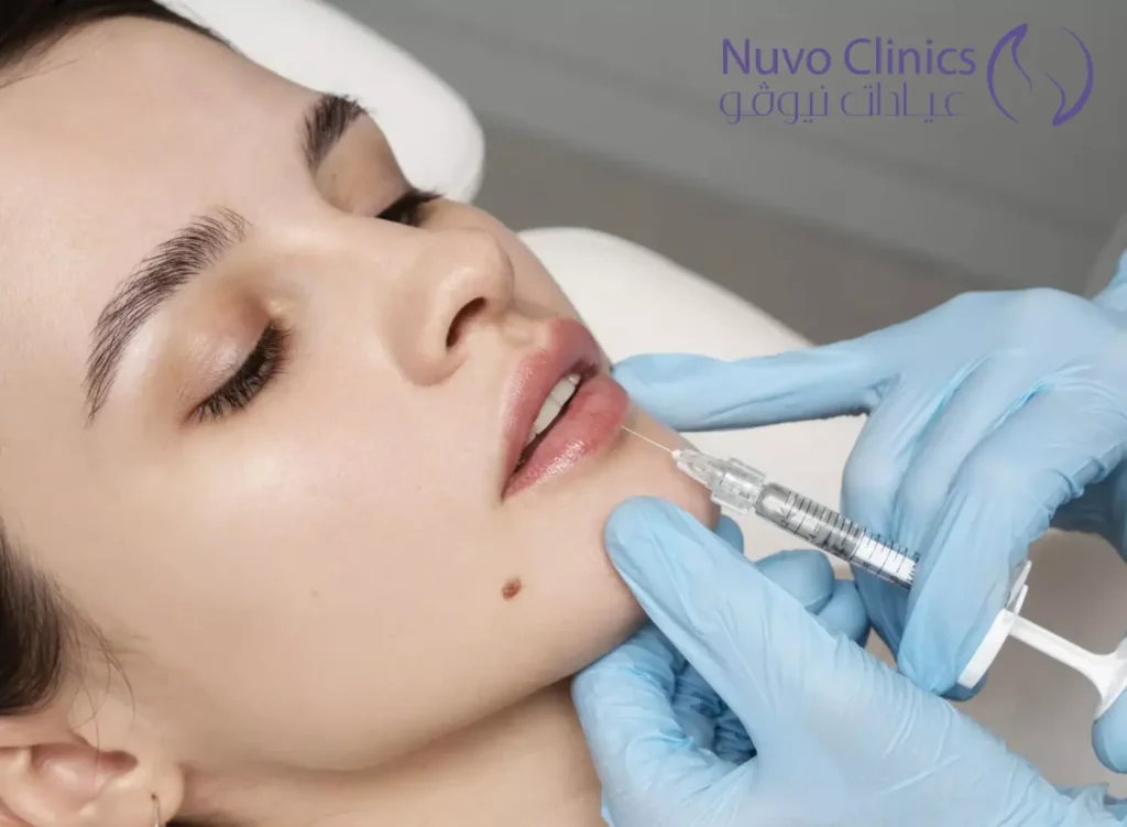 فيلر الشفايف