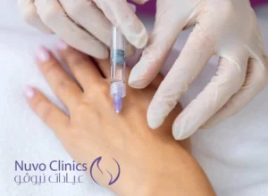 فيلر اليدين