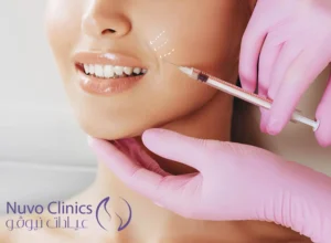 فيلر خطوط الابتسامه