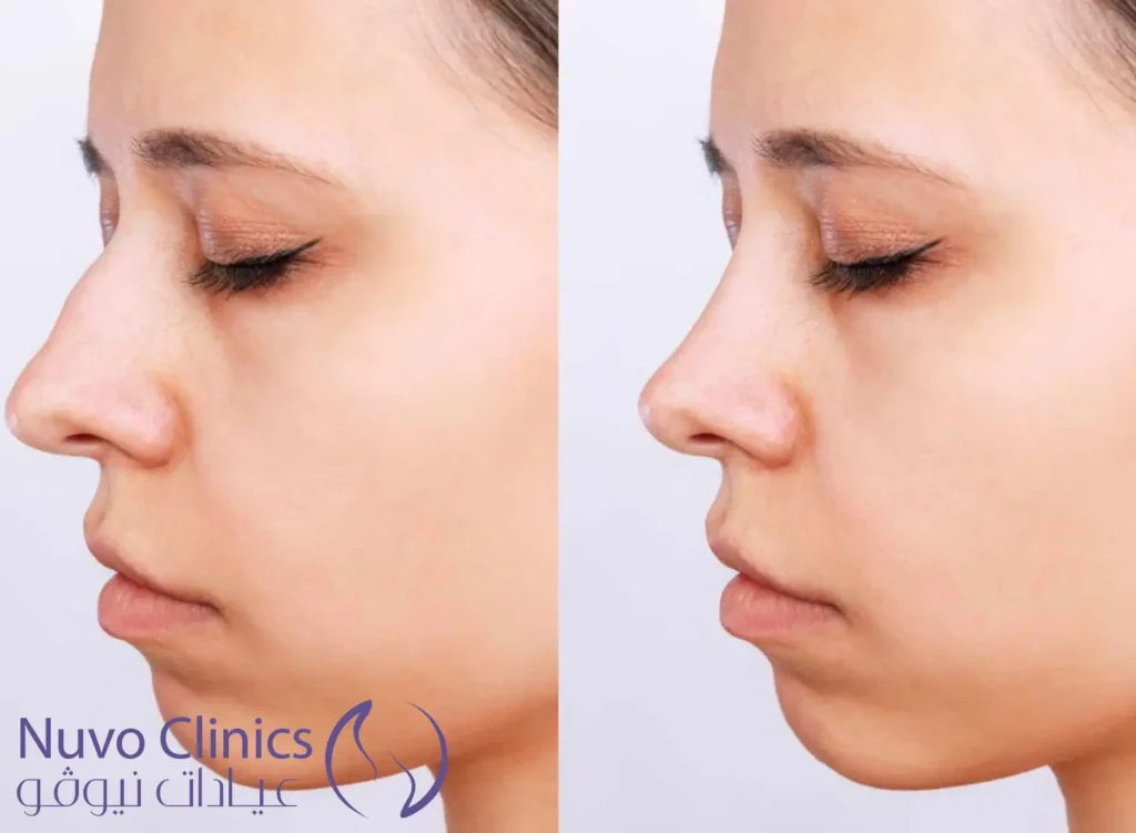 فيلر الانف قبل وبعد