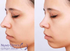 فيلر الانف قبل وبعد