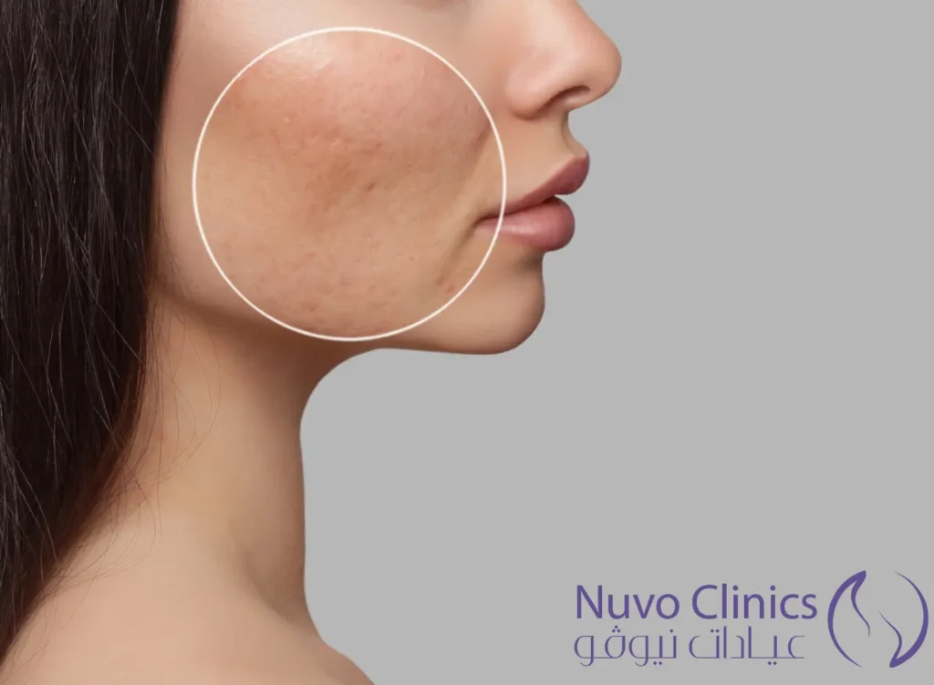 ليزر فراكشنال للندبات