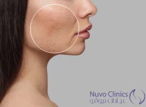 ليزر فراكشنال للندبات