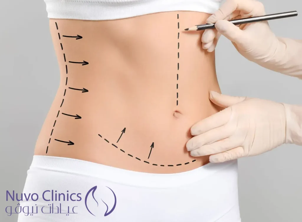 تجربتي مع عملية نحت الجسم